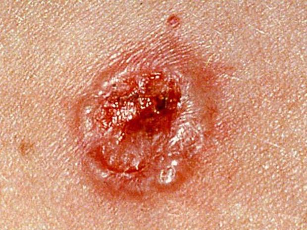 Skin Cancer Or Mole How To Tell Photo 1 Pictures Cbs News 