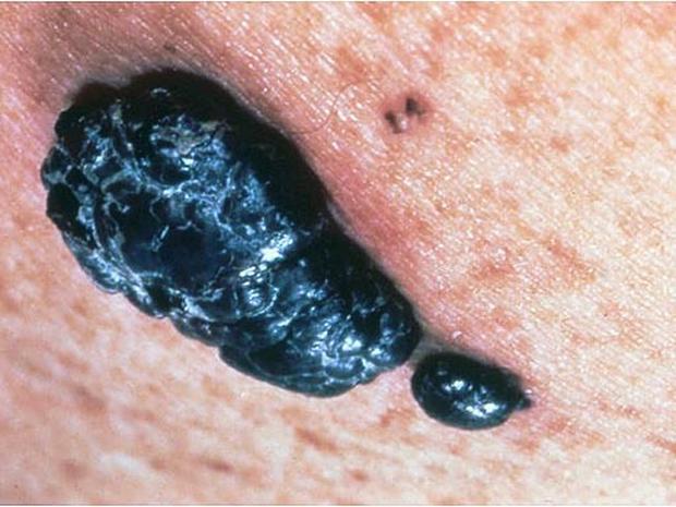Identifying Moles Skin Cancer Or Mole How To Tell Pictures Cbs News