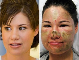 Bethany Storro, Acid Attack Victim, Released From Hospital, Says Attack Wont Stop Her From Living Her Life