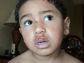 Boy Burned By Nacho Cheese Sues Disney