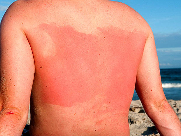 Sloughing Of Skin Radiation Sickness 8 Terrifying Symptoms 