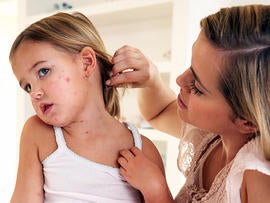 measles