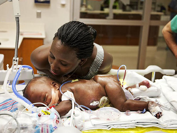 Medical Miracle Conjoined Twins Separated In Memphis Photo 4 