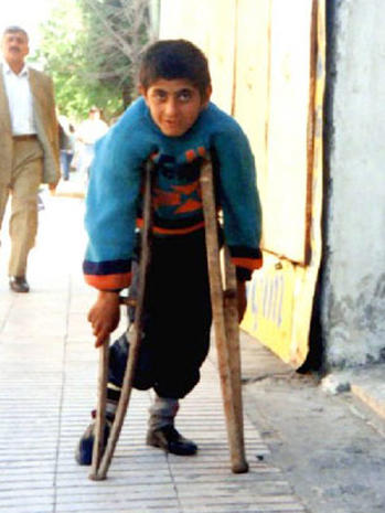 Poliomyelitis: 24 photos of crippling disease - Photo 14 ...