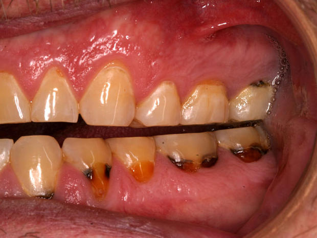 Meth Mouth Inside Look At Icky Problem Graphic Images Photo