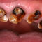 Meth Mouth Inside Look At Icky Problem Graphic Images Photo