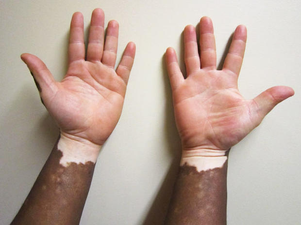 vitiligo-skin-disease-all-you-should-know-about-the-skin-disorder