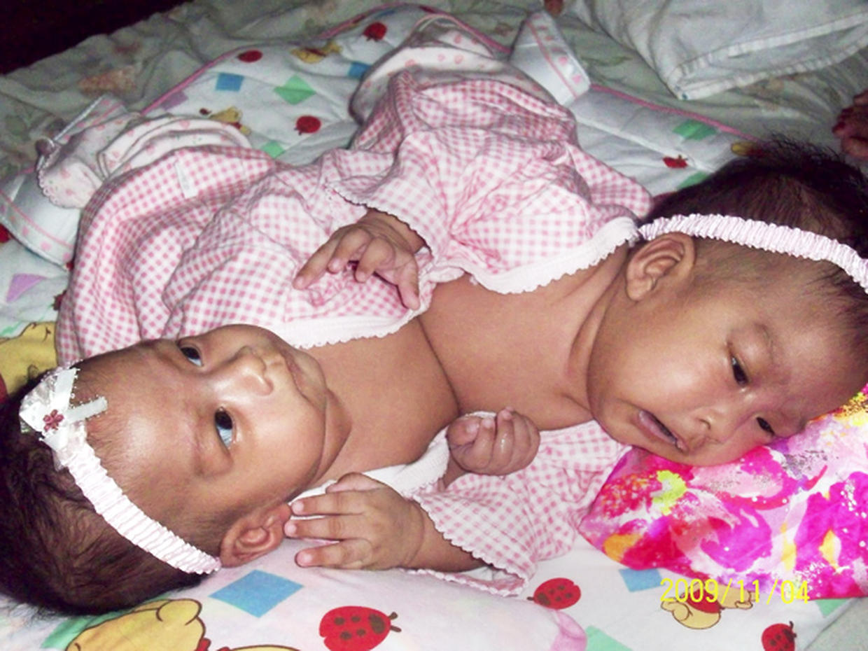 Conjoined Twins Amazing Photos Graphic Images Photo Pictures Cbs News