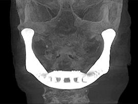 3d printed jaw