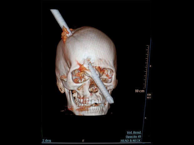 bar impales skull brazil
