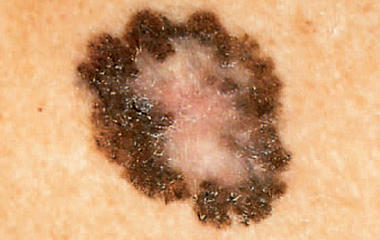 Is it skin cancer? 