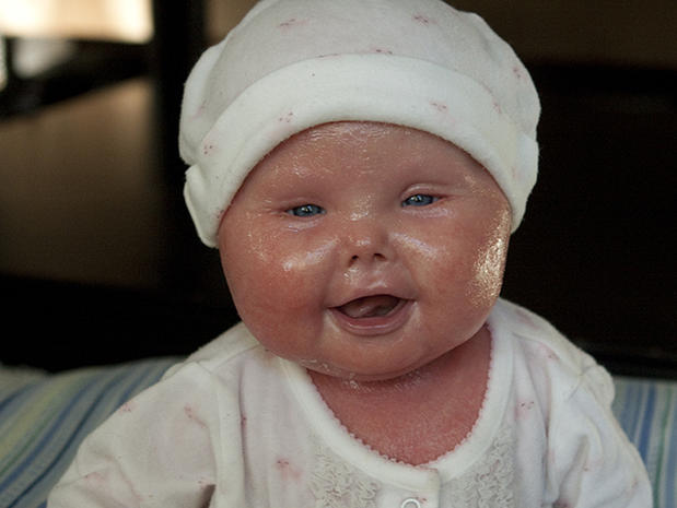 Meet Brenna, a baby with Harlequin Ichthyosis - Photo 22 ...