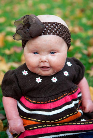 Meet Brenna, a baby with Harlequin Ichthyosis - Photo 2 ...