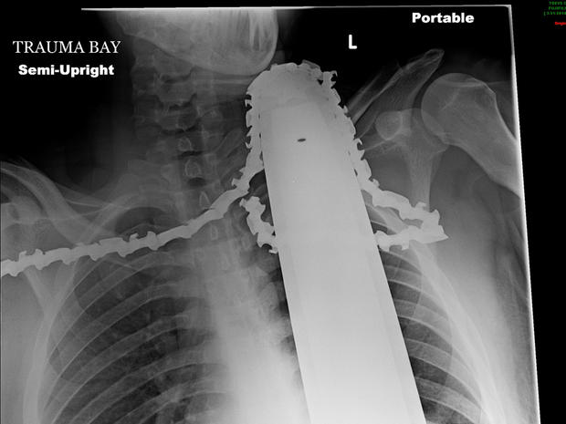 chainbar-xray.jpg