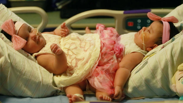 Conjoined Twin Girls Separated In Texas Surgery Cbs News 8220