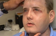 Face transplant recipient thriving one year after surgery