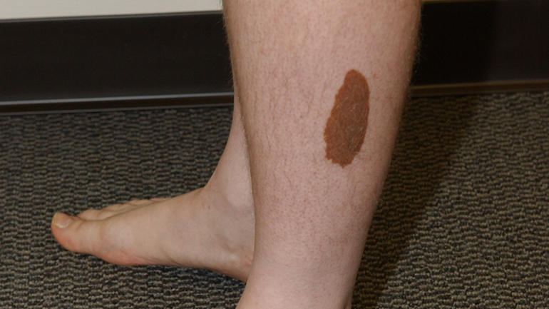 birthmark.jpg