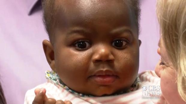 170321-cbs-news-baby-extra-legs04.jpg