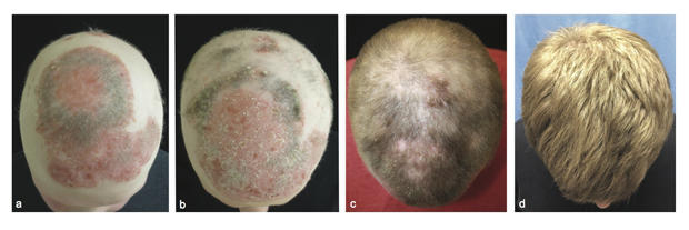 fármaco para la alopecia-cabello-jid-2014-0170-r1-figura-2.jpg