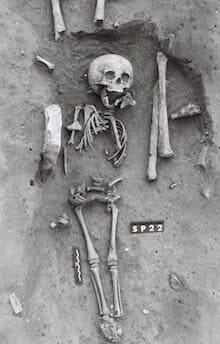 down-syndrome-skeleton-220.jpg