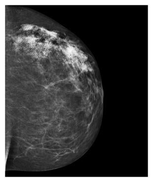 shea-hartman-mammogram.jpg
