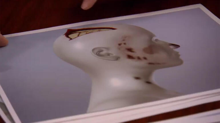 A model of Leslie Neulander's head injuries