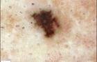 Representative skin lesion melanoma 