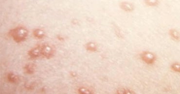 Shingles' Impact on Adults CBS News