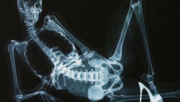 XXX X-Ray Pictures: Naked Anatomy Lesson Shocks Senses 