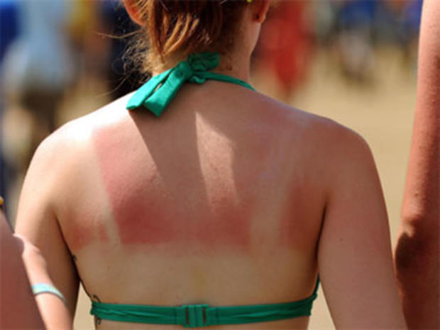 A woman suffering from sunburn photographed during the 2009 Glastonbury Festival in Pilton, Somerset. 