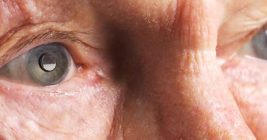 FDA Mini Eye Telescope Implant Can Bring Sight To Blind CBS News