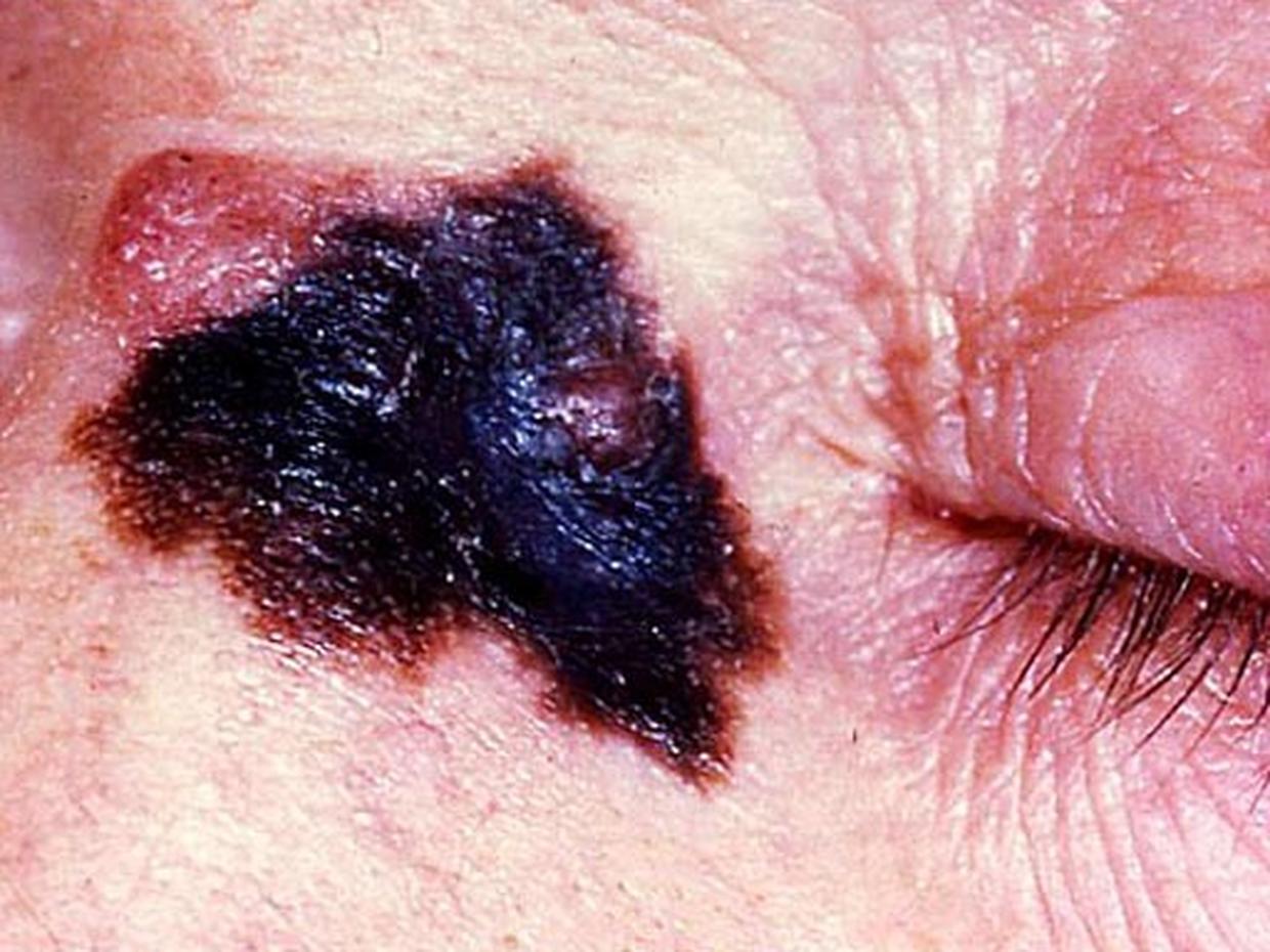 Skin Cancer Or Mole How To Tell Photo 1 Cbs News