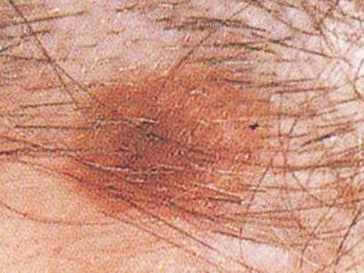 Skin Cancer Self Fefense Skin Cancer Or Mole How To Tell Pictures