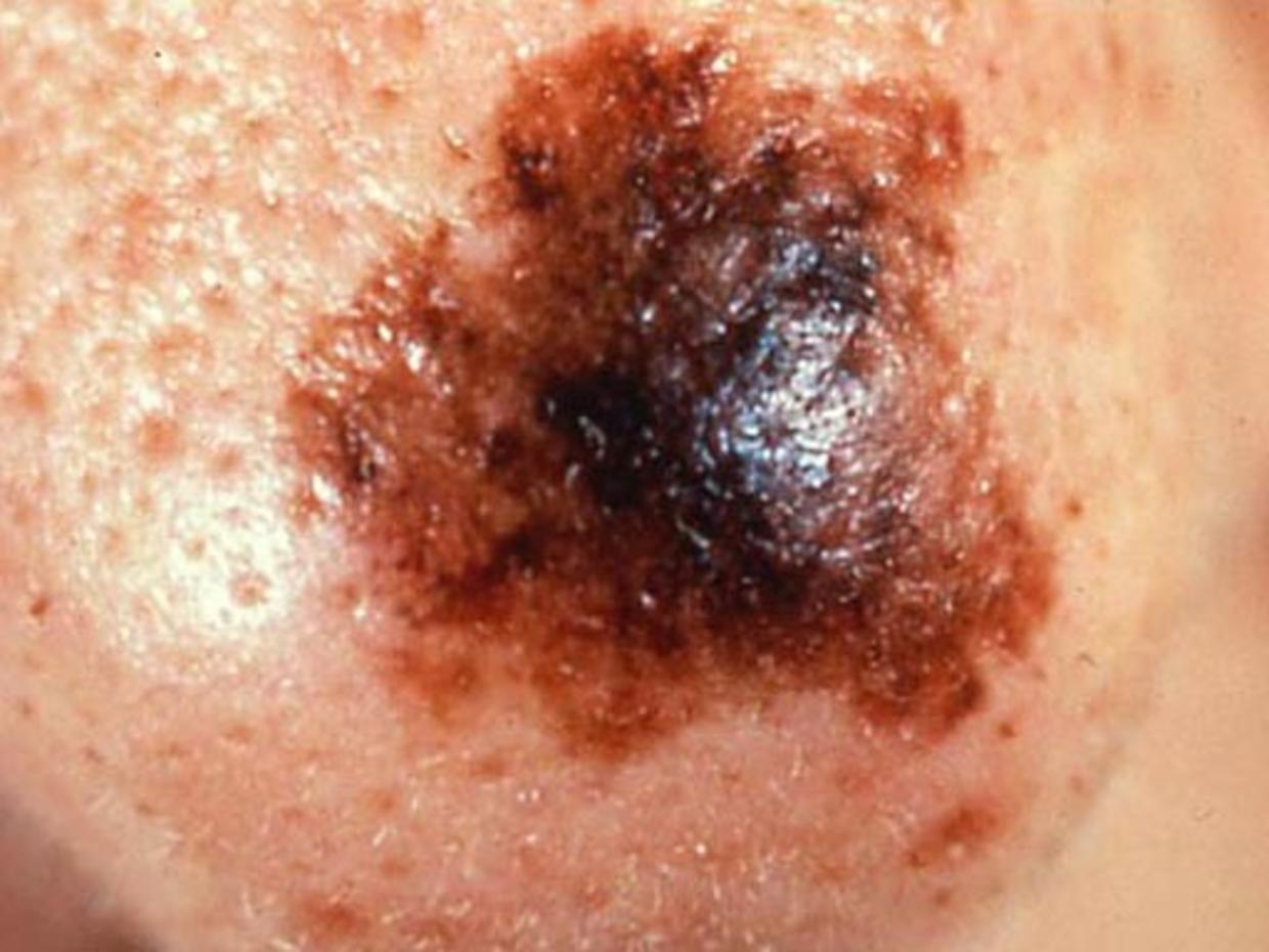 Skin Cancer Or Mole How To Tell Cbs News