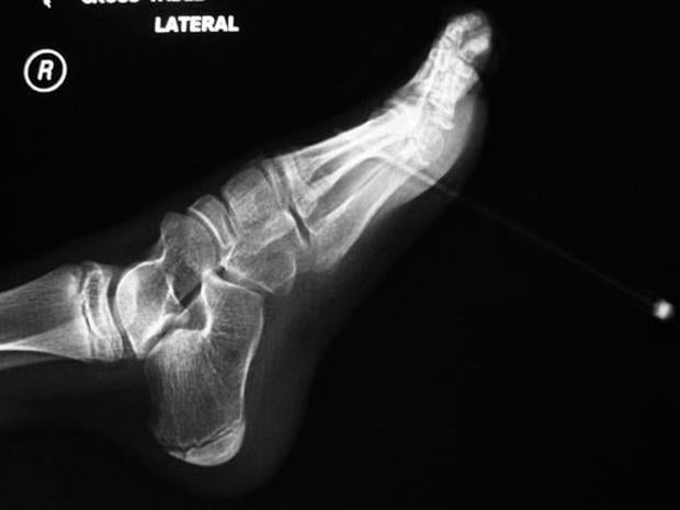 utah dc power scans   Pictures Swallowed blade   Shocking medical razor