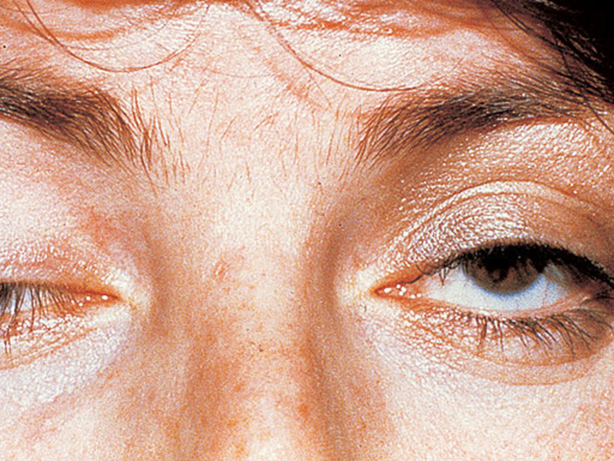 Слабость глаз. Миастения и миастенический синдром. Заболевание миастения Гравис.