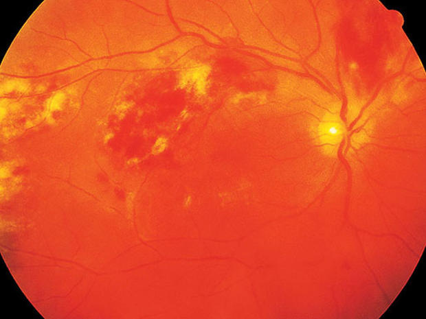 HIV-AIDS-retinitis_1.jpg 