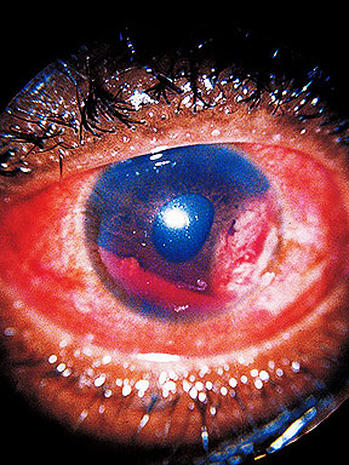Metastatic Cancer 12 Scary Things Your Eyes Say About Your