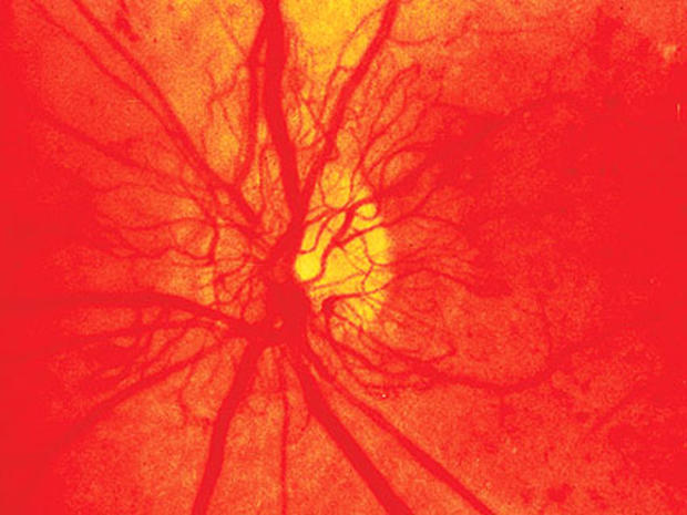 Proliferative-Diabetic-reti.jpg 