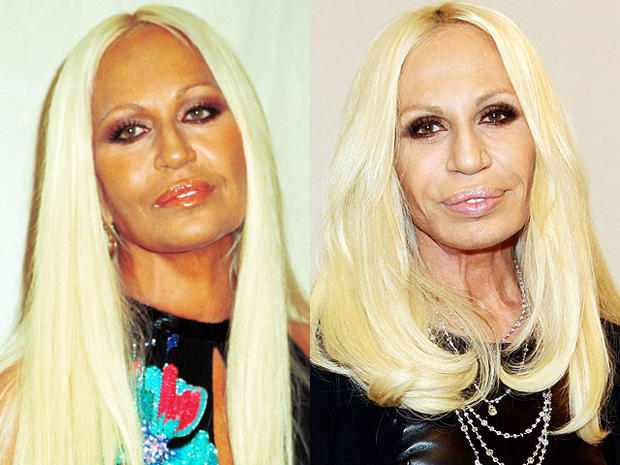Image result for donatella versace before and after plastic surgery