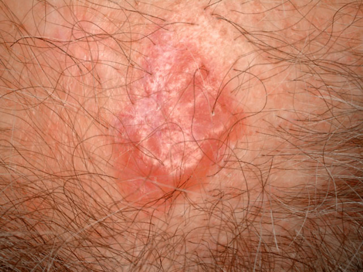 is-it-skin-cancer-cbs-news