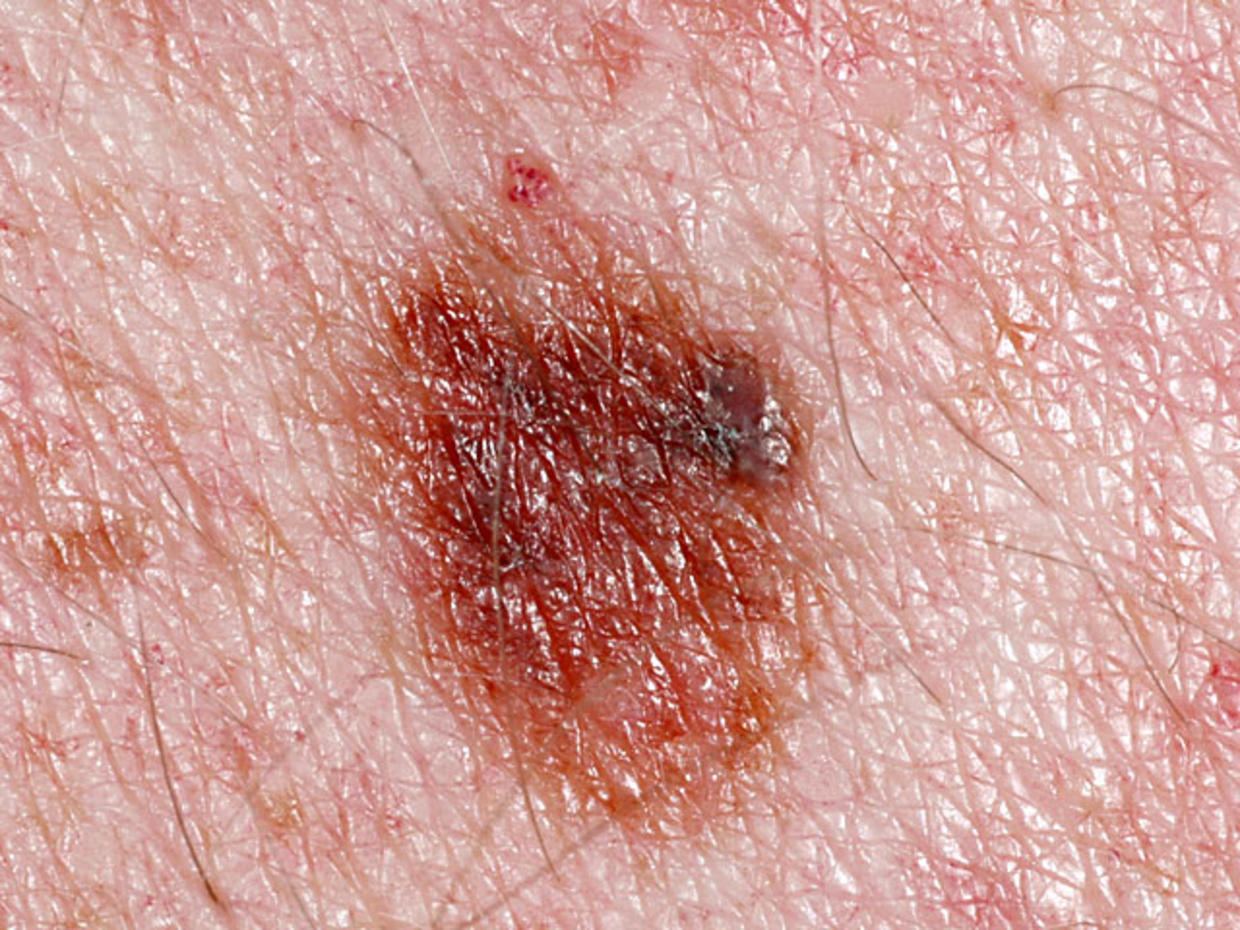 Skin Cancer As Related To Cancers Pictures
