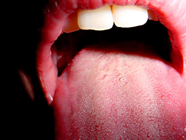 human papillomavirus mouth