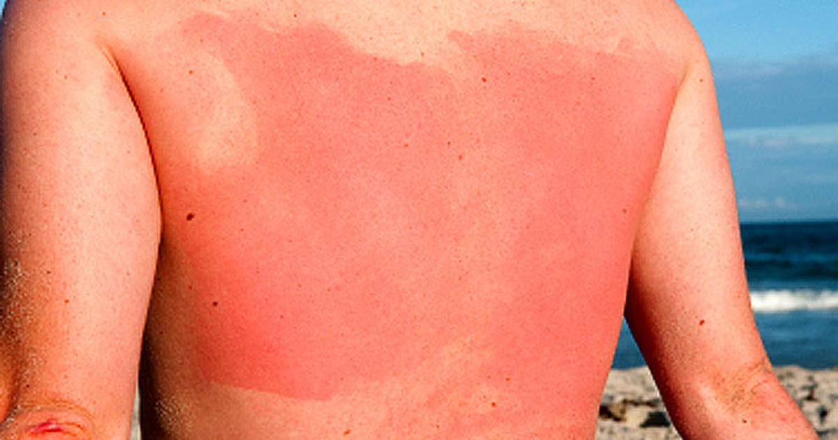 New Clues About Why Sunburn Is So Painful Cbs News