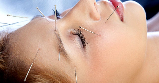 Acupuncture For Kids Deemed Safe By Pediatricians CBS News
