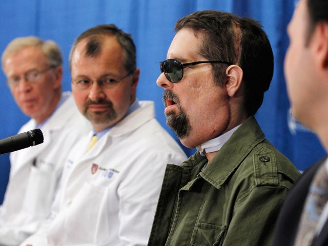 Dallas Wiens Amazing New Face Cbs News