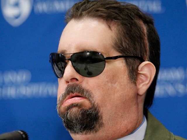 Dallas Wiens Amazing New Face Cbs News