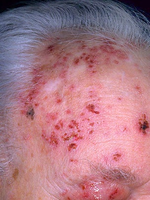 Is it shingles? 7 myths about painful illness (graphic images) CBS News