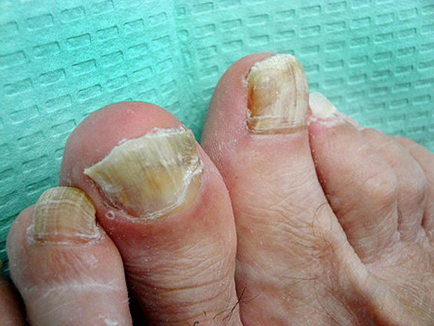 Ouch 7 Nasty Foot Flaws And How To Fix Them Graphic Images Cbs News 8883