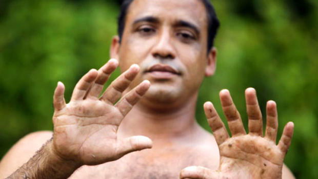 Man with 12 fingers, 12 toes calls them "blessing" - CBS News